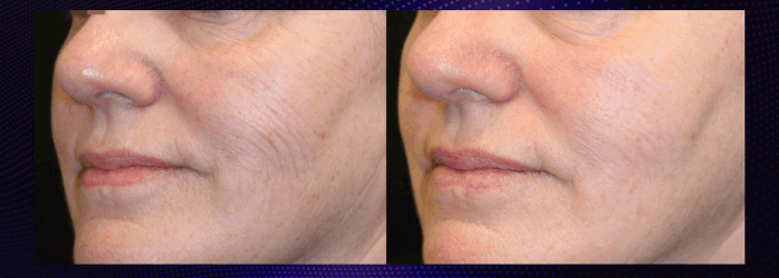 before and after from opus plasma