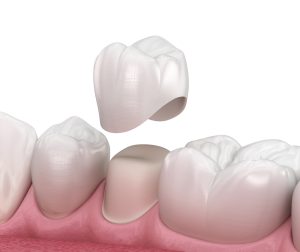 dental crowns in Denver, CO